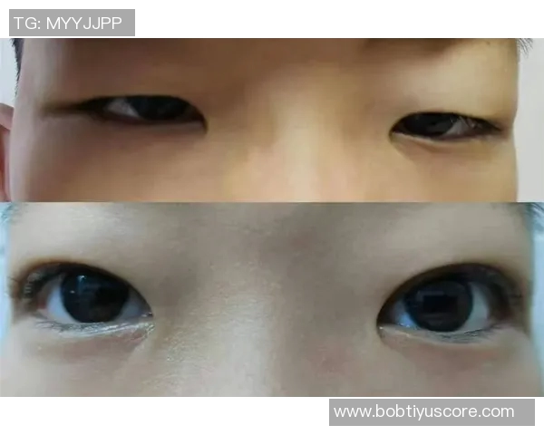 西媒揭示赫伊森眼睛难以睁开的原因是先天性眼睑下垂但不影响视力